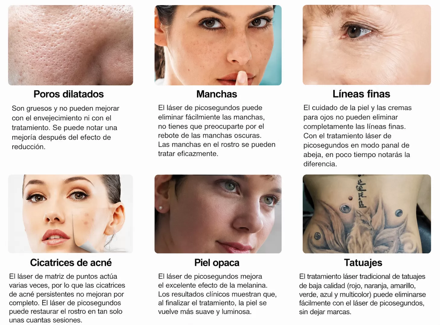 Removedora de tatuajes 3